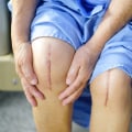 Expert Tips for Recognizing a Blood Clot After Knee Replacement Surgery
