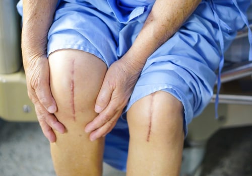 Expert Tips for a Safe and Successful Recovery from Knee Replacement Surgery