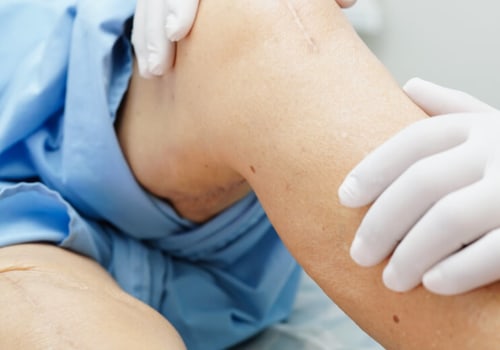 Expert Tips for a Successful Knee Replacement Surgery