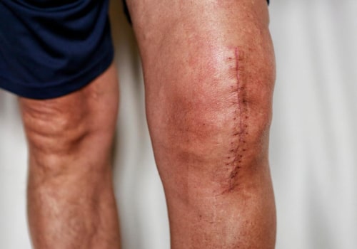 Expert Tips for Managing Swelling and Inflammation After Knee Replacement Surgery